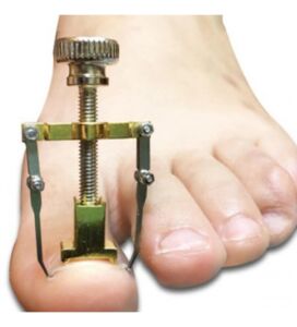 Orthopedia Batık Tırnak Çıkartıcı Aparat